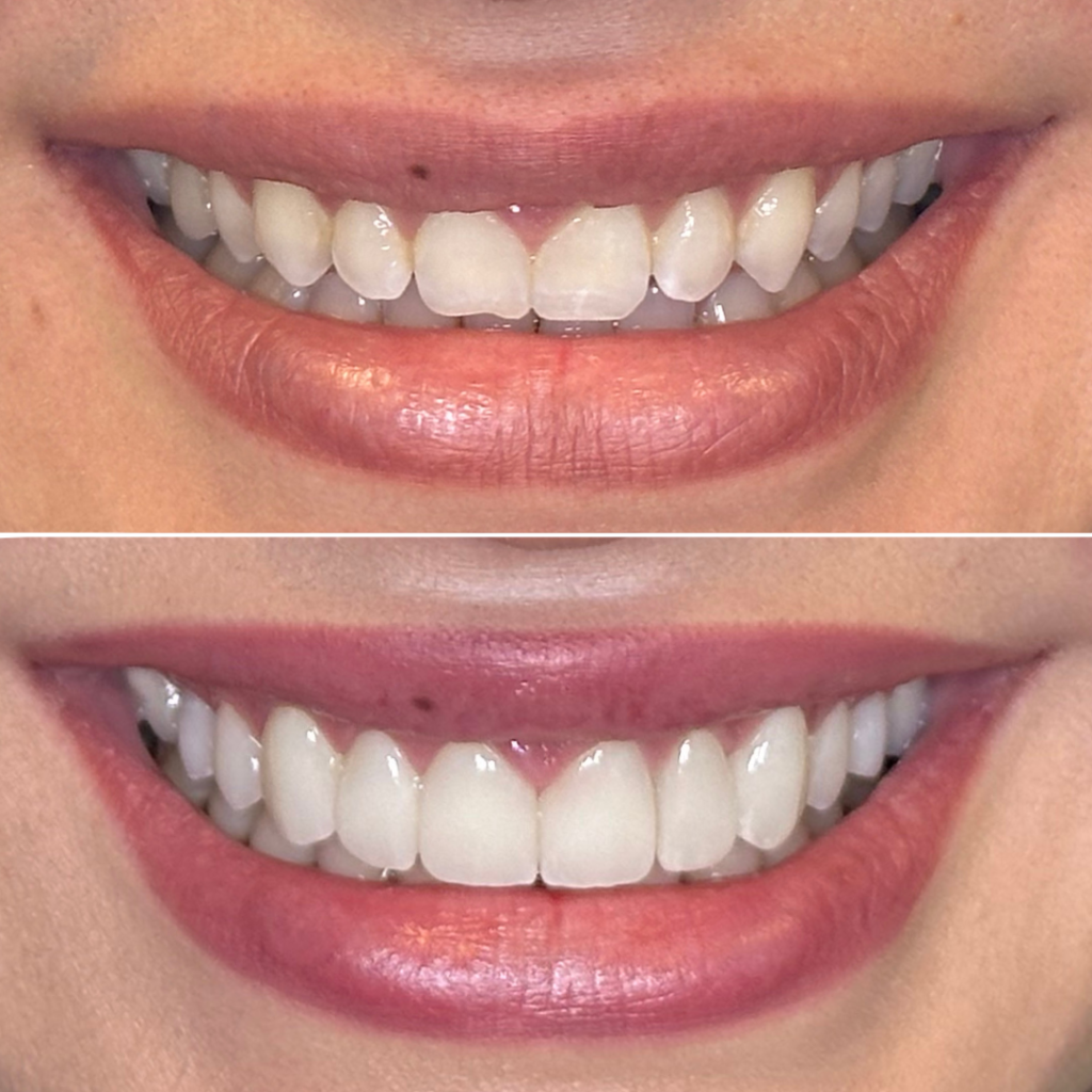 PORCELAIN VENEERS Before and After
