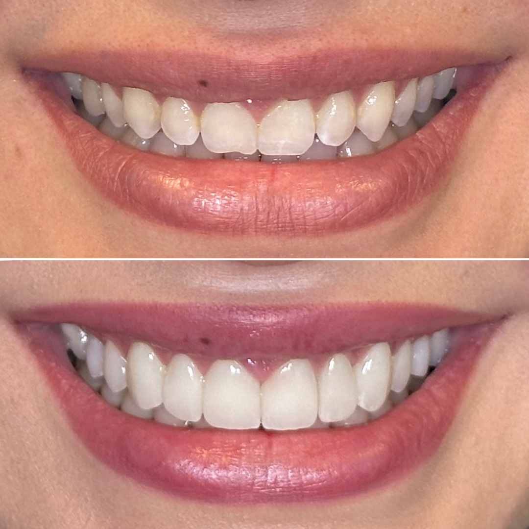 Composite Veneers vs. Porcelain Veneers | 32ology Dental Studio