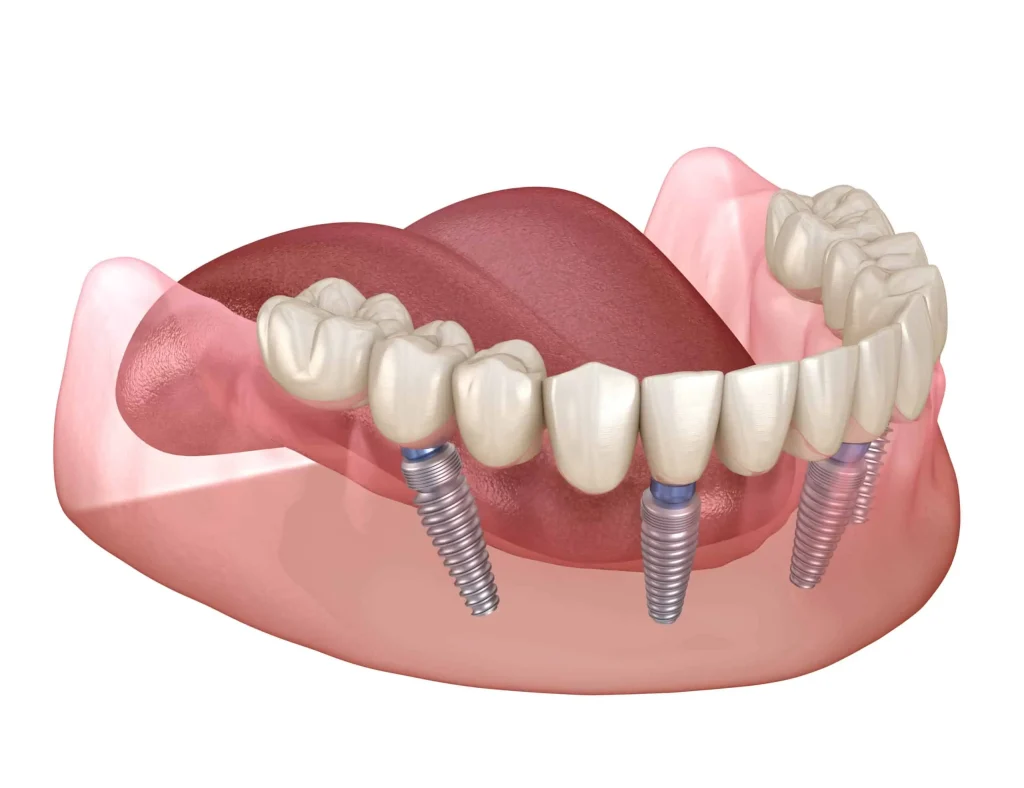 implant dentures 4 implants