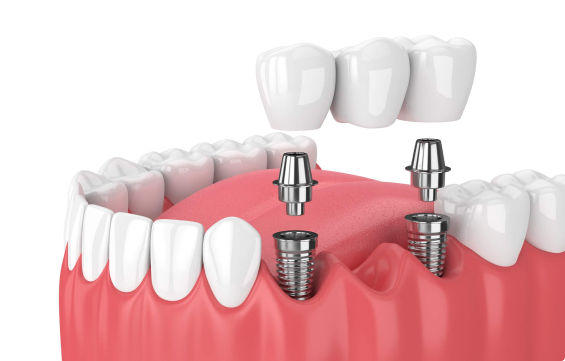 dental implant with custom abutment and implant supported crown