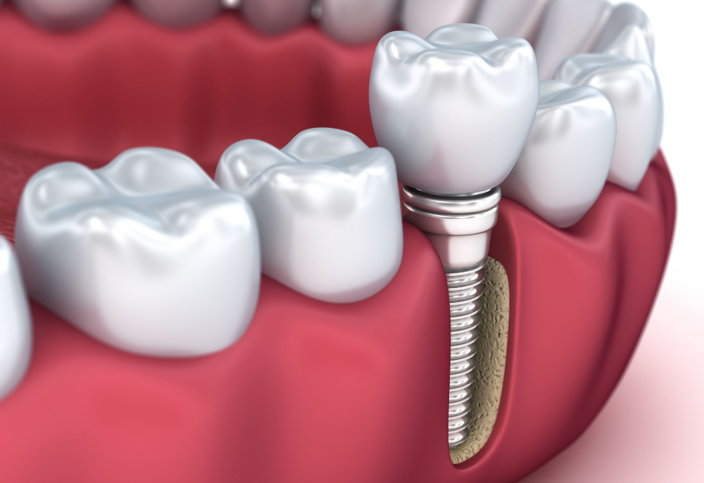 Dental implant with implant supported crown