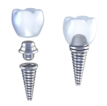 Dental implant diagram being attached together