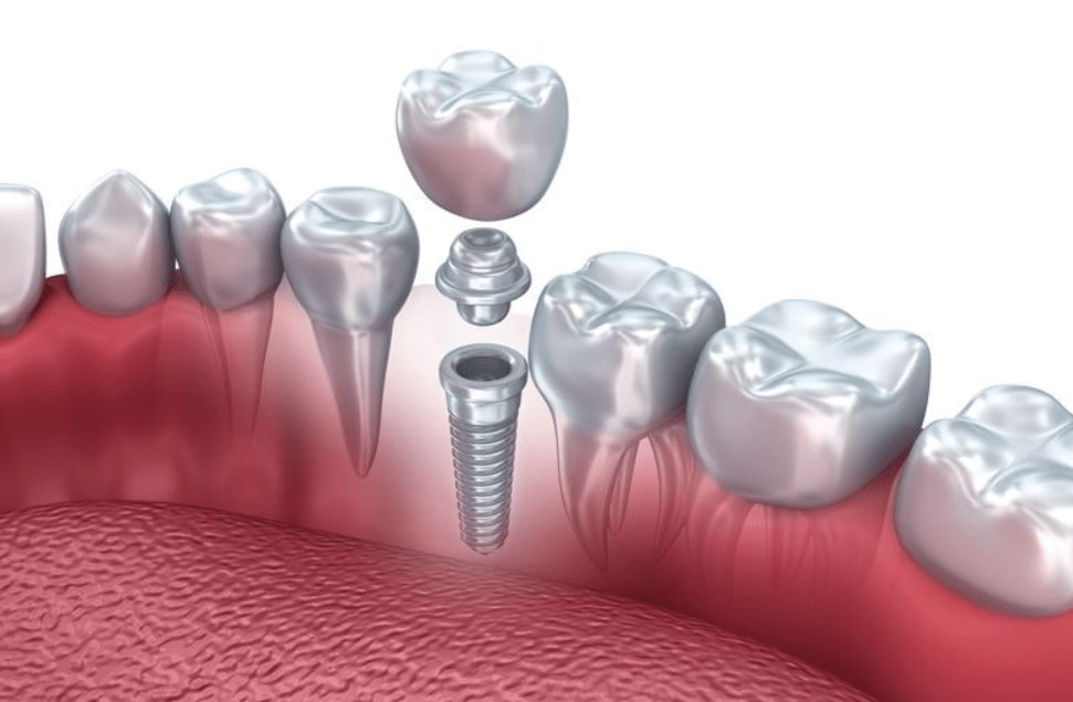 dental implant with custom abutment and abutment supported crown